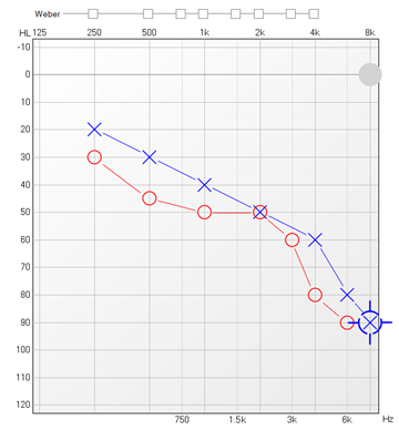 A sample of an audiogram